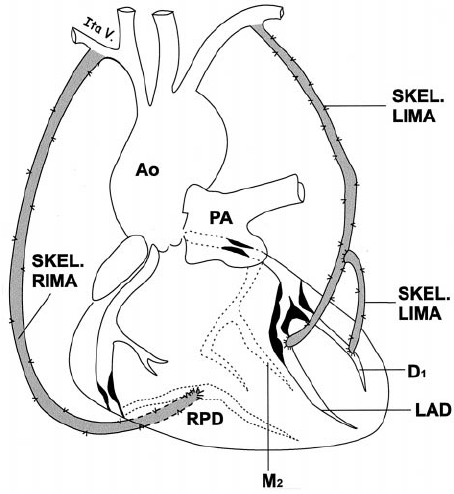 σν Fig-4-In-situ-right-internal-mammary-artery-RIMA-to-right-coronary-artery-and-left